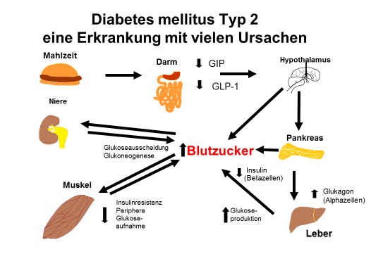 diabetes mellitus 2 definition