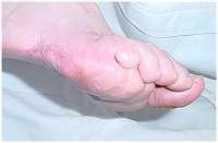 Diabetes News Nervenschaedigung