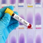 LDL-Cholesterin führt zu Arteriosklerose und schädigt die Gefäße