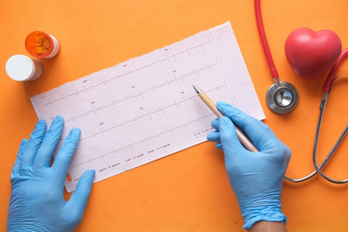 Vorhofflimmern bei Diabetes bleibt oft unbemerkt